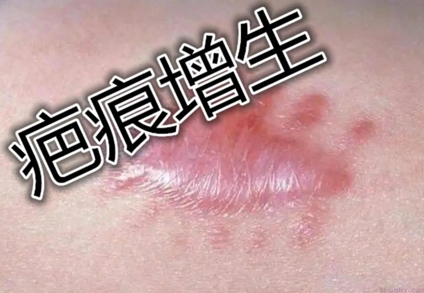 增生疤痕祛除方法及护理技巧